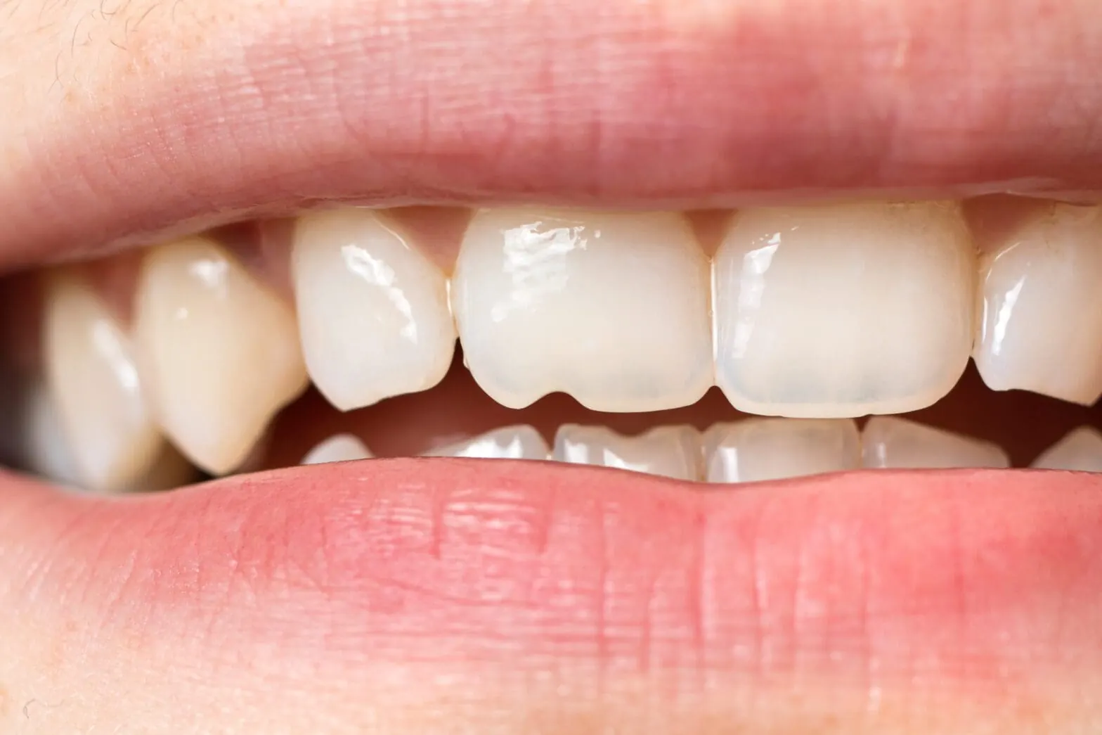 Chipped tooth repair image