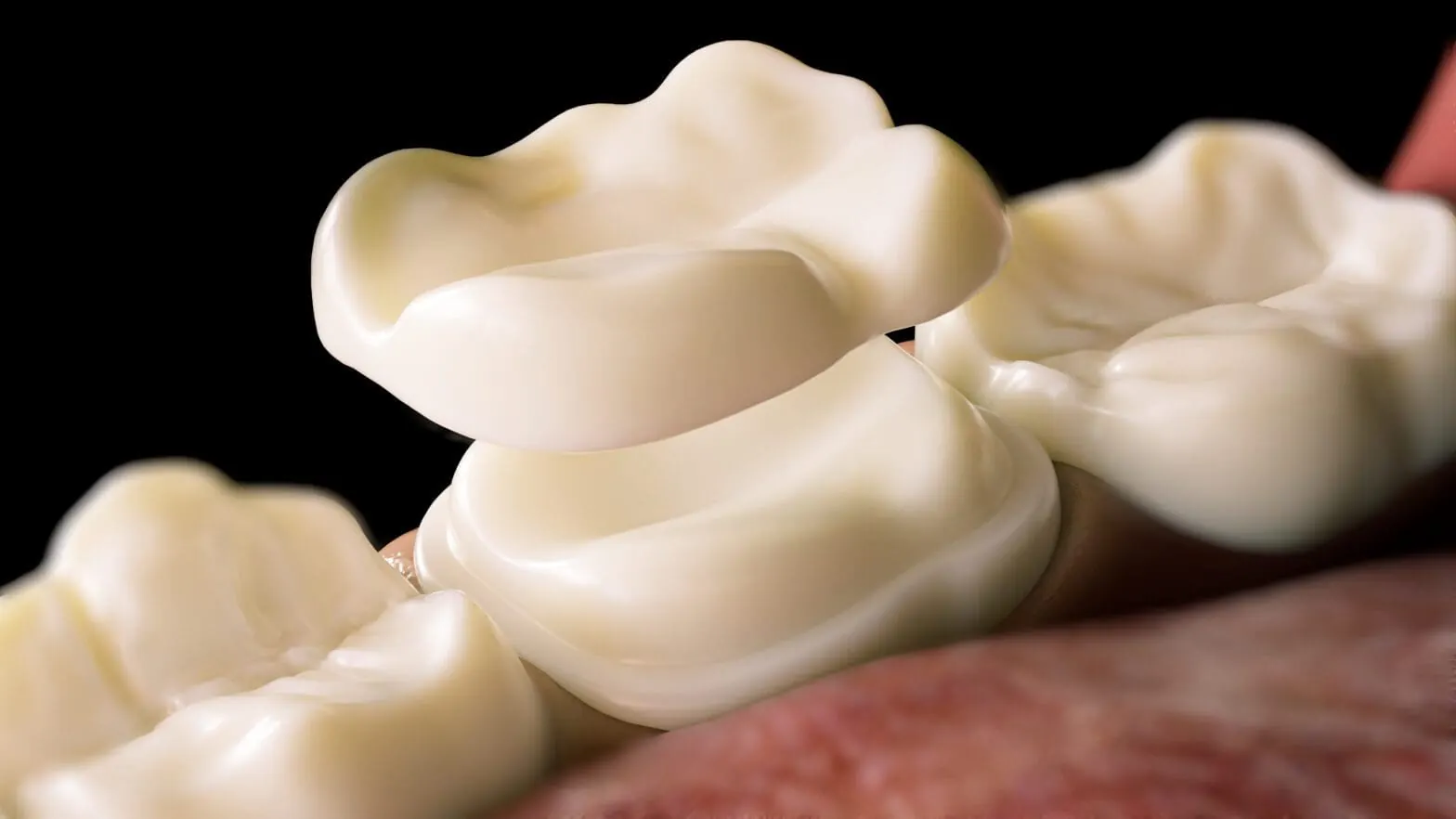 Dental crown treatment image
